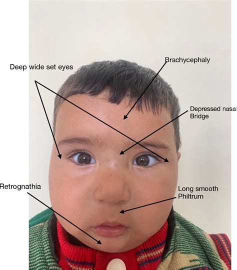 bardet-biedl syndrome 1